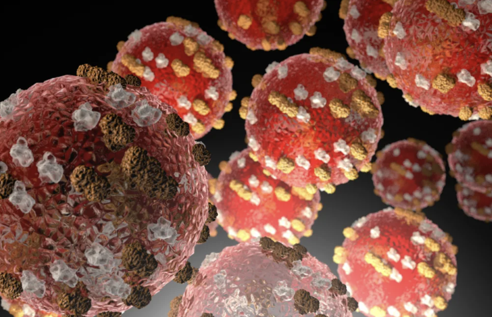 New measles case confirmed in Queenstown