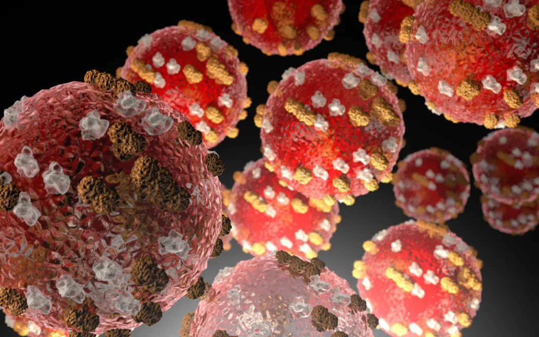 New measles case confirmed in Queenstown